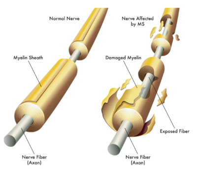 Demyeliination from MS diagram