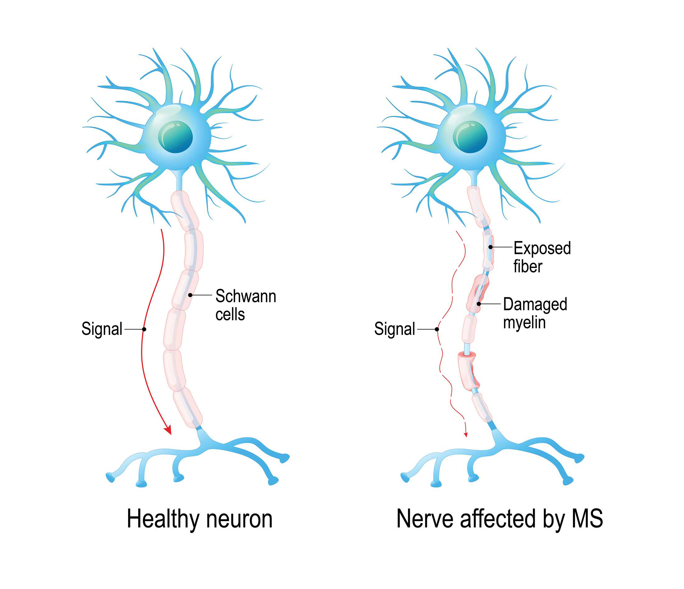 How MS Affects Nerve Flow