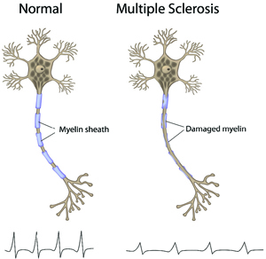 MS Attack (Relapse): Symptoms, Triggers, What To Do