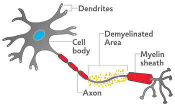 Illustration of MS damage to the myelin of a nerve cell