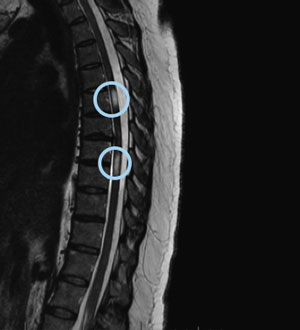 T2 thoracic spinal cord image with lesions (circled)