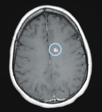Axial T1 image with gadolinium of the brain showing an enhancing lesion (circled)