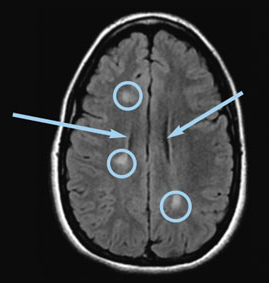 Axial FLAIR image of the brain showing lesions as white (circled) and fluid as black (see arrows)
