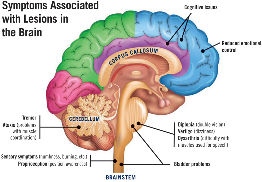 Symptoms Associated with Lesions in the Brain