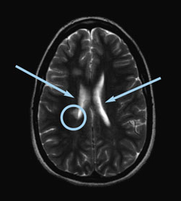 Axial T2 image of the brain showing a lesion as white (circled) and fluid as white (see arrows)