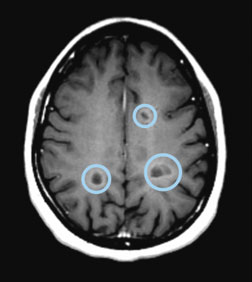 Axial T1 image of the brain showing black holes (circled)