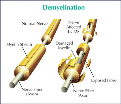 Illustration of MS damage to the myelin of a nerve cell